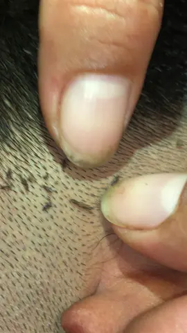 Remove lice #omg🙀🙀🥶🥶🥶😱❤️❤️ #lice #liceremoval 