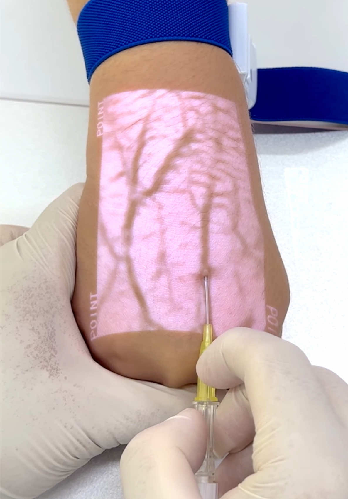 Demostración de venoclisis en el dorso de la mano con el detector de venas Hellovein Lite 2.0 💉 #nurse #enfermeria #hospital #intravenosa #vena 