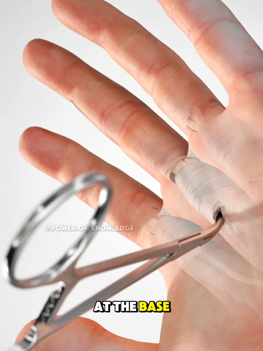 Ever wondered how Trigger Finger Surgery is done? 👇Trigger Finger Release Surgery helps fix a finger that locks or clicks due to a tight tendon sheath. Watch how surgeons carefully release the trapped tendon and restore smooth movement. #SurgeryVideo #TriggerFingerRelease #MedicalAnimation #TriggerFinger  #TriggerFingerSurgery