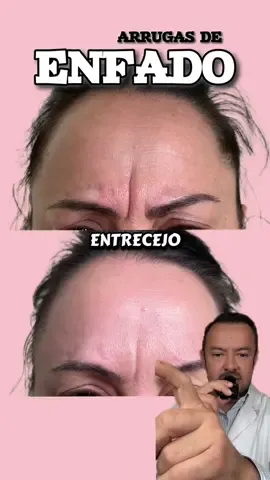 Arrugas de enfado, arrugas del entrecejo!!! #neuromodulador #arrugas #enfado #botox 