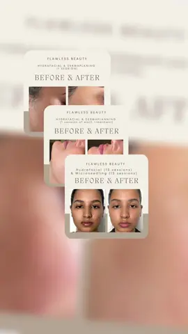 ✨Combination Treatment - Hydrafacial & Dermaplaning (1 session)✨Look at that flawless glass finish. Absolutely love love love. On offer for £70 until 22.10.25 rrp. £95. DM to book or any queries.  #beauty #facial #dermaplaning #hydrafacial #skincare 