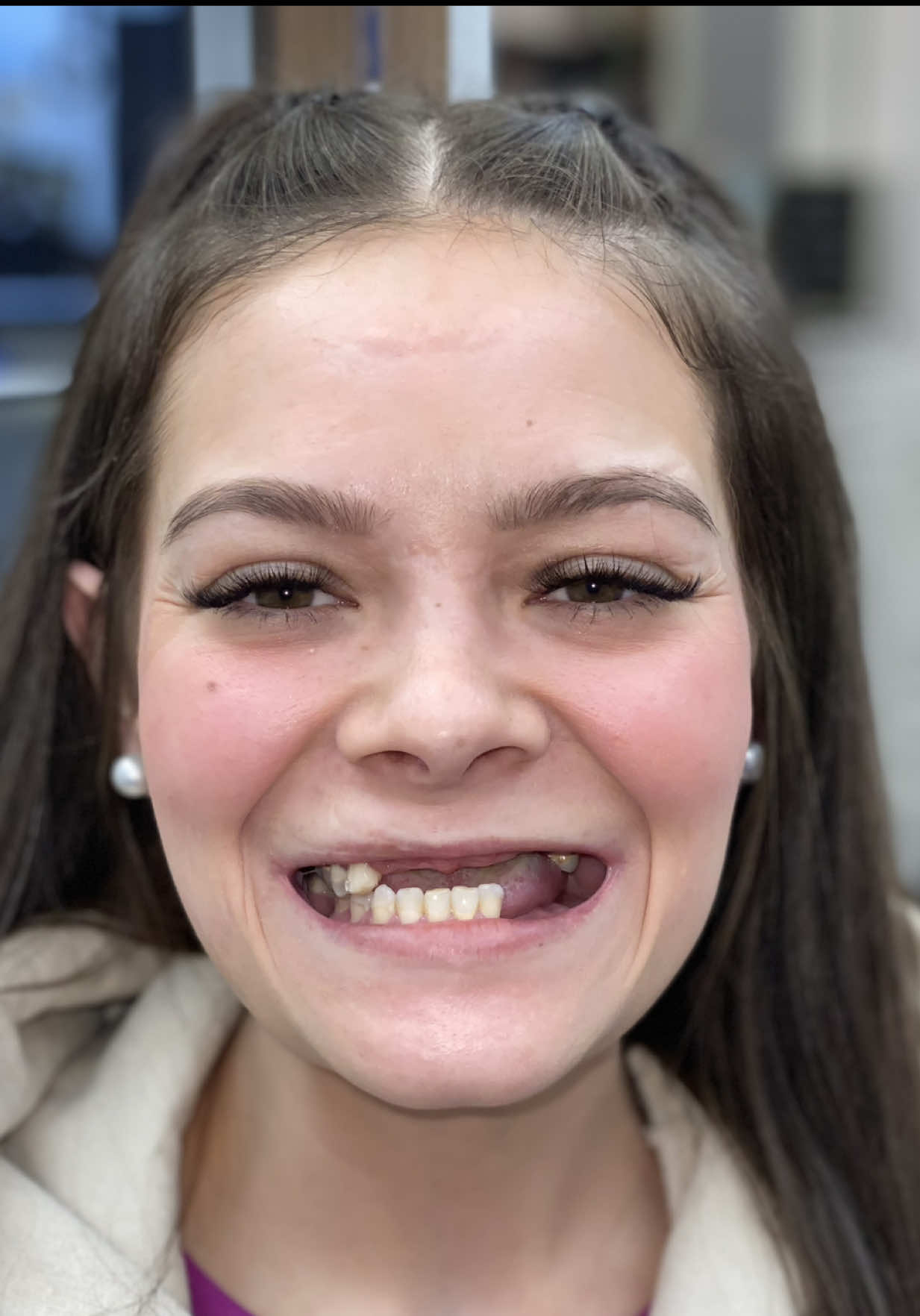 Chassidy was in a life altering car crash…with her whole body mangled, she fought her way back. This story is about self love and courage even when all hope seems lost. Her husband nursed her back to life…All she needed was the one thing to put that light finally back into her smile. #dentistry #accident #beauty #drkennysmiles #makeover 