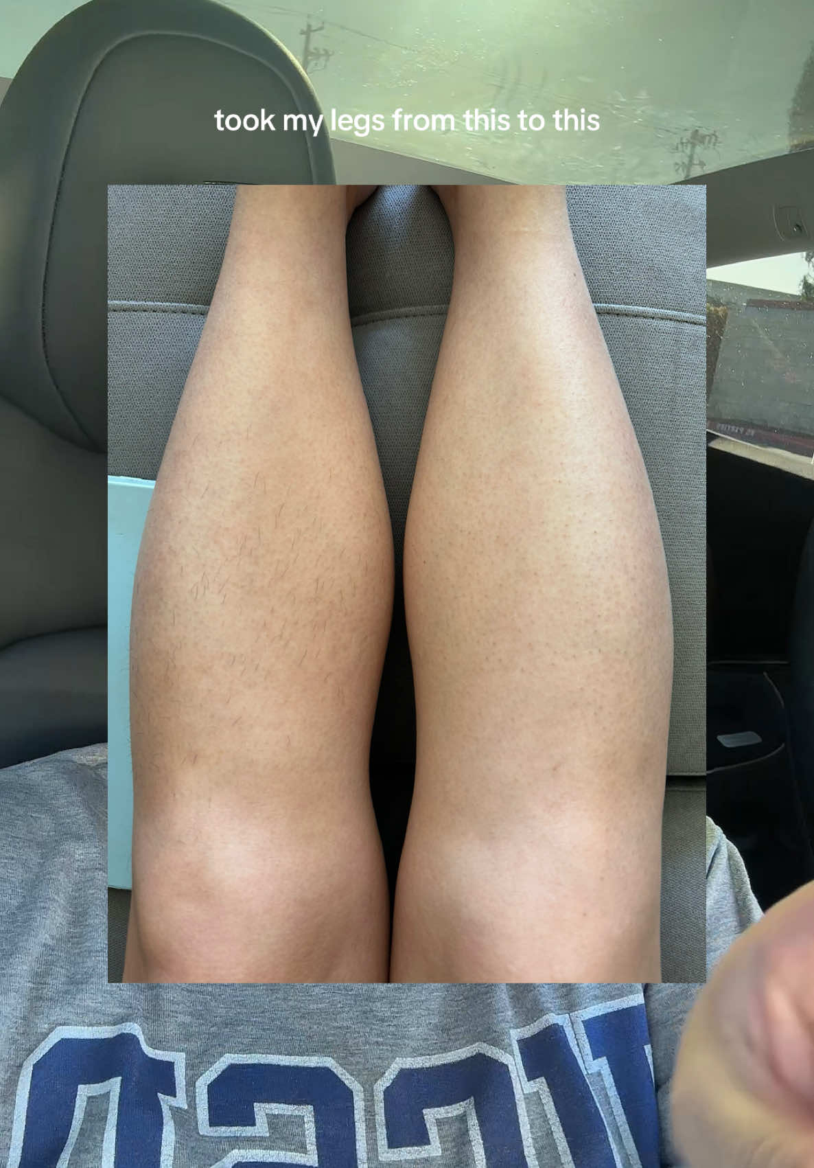 No more shaving or waxing. At home easy hair removal device that works. Perfect gift for her. #tiktokshopfalldealsforyou #tiktokshopcreatorpick 
