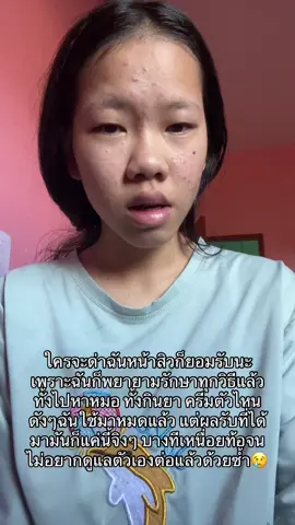 ใครไม่เป็นไม่รู้หรอก😣 #สิว #ปัญหาสิวกวนใจมาทางนี้ #fyp 