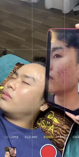 Cập Nhật da mụn thâm #lqspa #hocnghespa  #chamsocda #lequynhspa #vienthammylqspa 