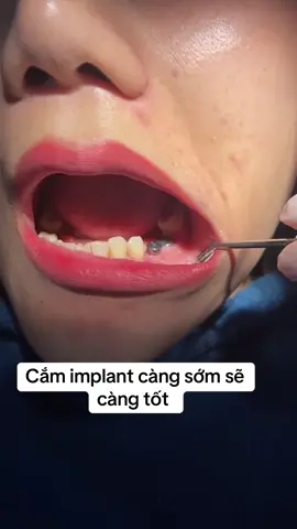 Cố gắng sớm nhất có thể#nhakhoanganphuong #drtuan #vietkieu #rangsuthammy #implant 