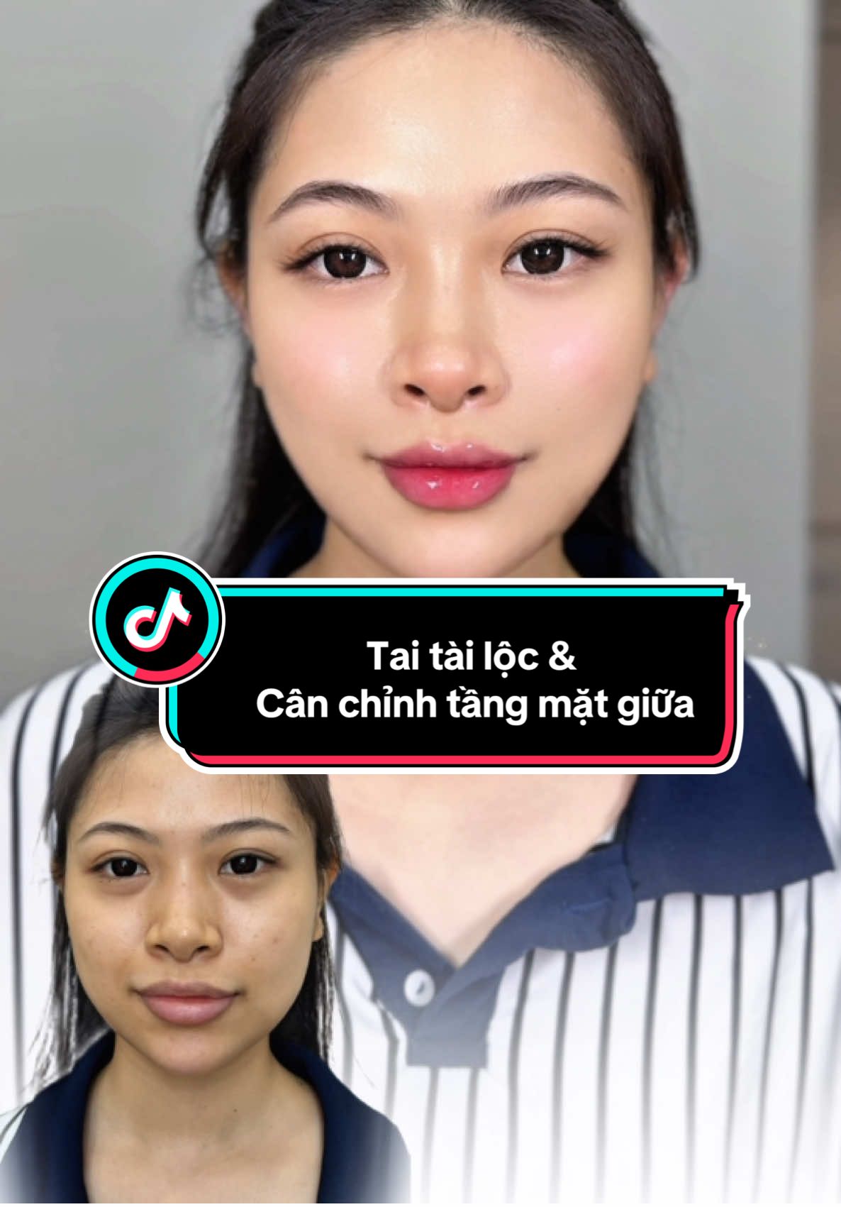 Khuôn trang đầy đặn - nét ngài nở nang  Đẹp rạng ngời tự nhiên chỉ với combo nâng nầng mặt giữa, và kết hợp với tai tài lộc thì hậu vận rất tốt nha cả nhà 🥰  #bacsitiemmoidep #tiemfiiler #nangtangmatgiua #taitailoc #tiemtaivenhtrunghoa 