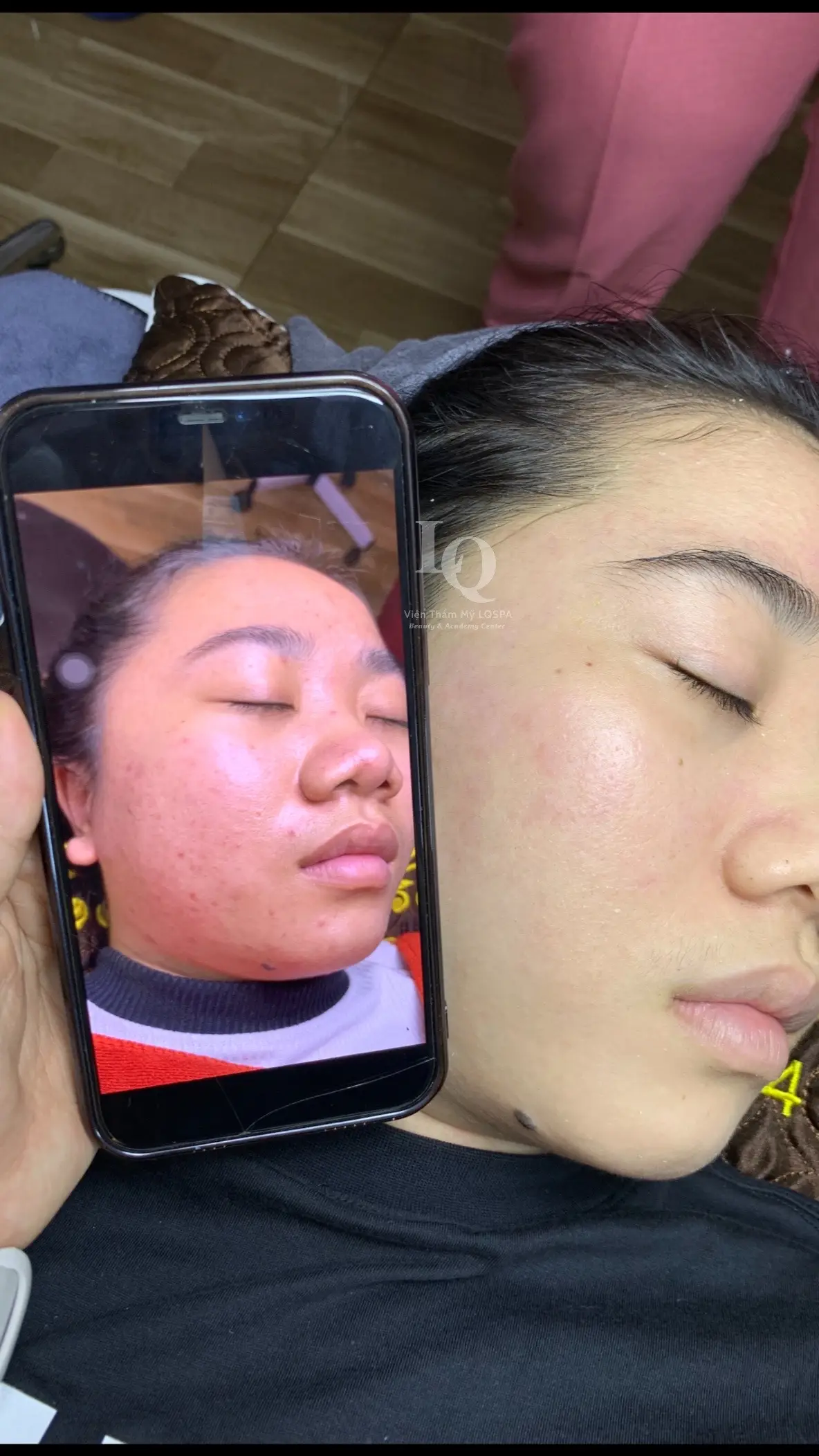 Cập nhật da mụn #nanmunbangtambong#chamsocdaseo#chamsocda#chamsocdamun#chamsocdanam     