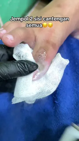 #cantengan #ingrownnail #pedicuretime #fyp #masukberanda 