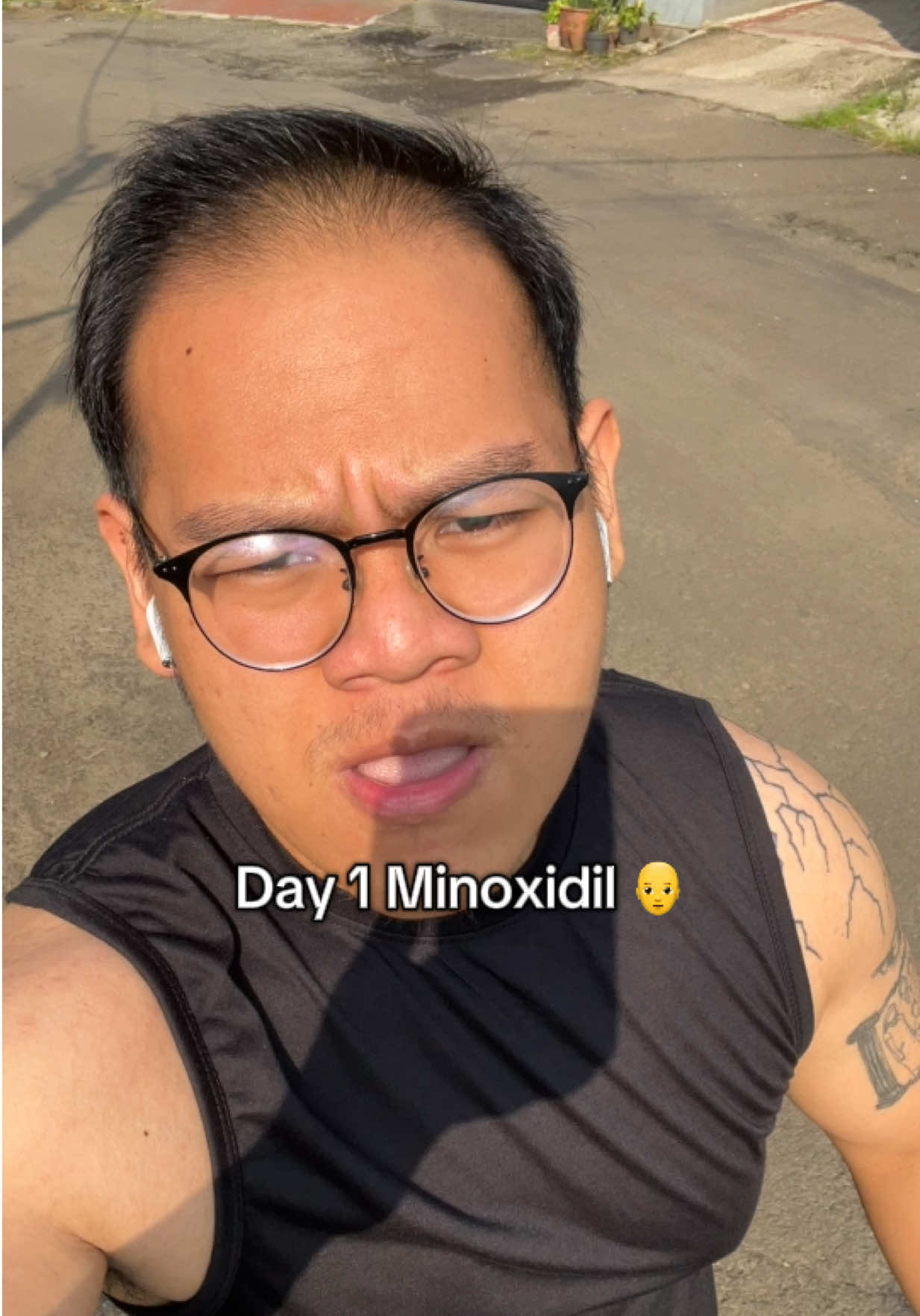 365 days later… worth every drop. 💧  🧑🏻‍🦲to 👦🏻 #minoxidil #hairloss #kebotakan 