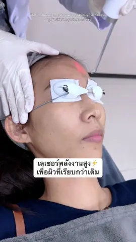 เลเซอร์พลังงานสูง⚡️เพื่อผิวที่เรียบกว่าเดิม #ดูแลผิว #พิโค่เลเซอร์ #ลดฝ้ากระจุดด่างดํา #tiktokป้ายยยา #เรื่องผิวหน้าต้องpattippaclinic  @หมอเต้หมอเธีย เคลียร์เรื่องผิว  @หมอเต้หมอเธีย เคลียร์เรื่องผิว  @หมอเต้หมอเธีย เคลียร์เรื่องผิว 