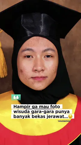 “Hampir ga mau foto wisuda gara-gara punya banyak bekas jerawat…” 😔 Tapi ternyata, dengan @mop.beauty Ultra Cover Long-Lasting Powder Foundation, semuanya berubah 💖 Cover-nya strong banget tapi tetap ringan di kulit — hasilnya halus, natural, dan bikin percaya diri lagi ✨ Sekarang malah bangga tampil depan kamera, karena bekas jerawat bukan lagi alasan buat sembunyi 💪 #centerofattention #powderfoundation #MOPBeauty #makeuptransformation #flawlessskin 