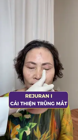 Rejuran trẻ hóa mắt: tái tạo collagen, làm đầy nếp nhăn, cho đôi mắt không tuổi! Nhắn tin ngay để nhận mã ưu đãi GIẢM 2/3 GIÁ!#TikTokAwardsVN #thammylinhanh #rejuran #trungmat #canchinhkhuonmat 