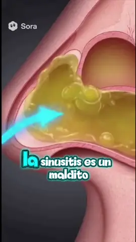 Cómo reconocer los síntomas tempranos de la sinusitis #sinusitis #prevención #salud #bienestar #cuidado 