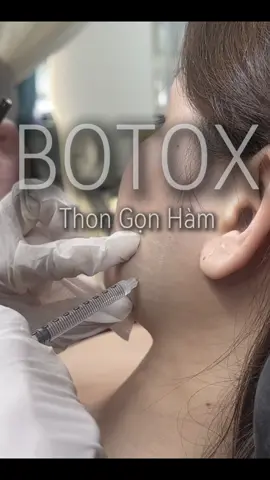 Botox gọn hàm hiệu quả sau 2 tuần rõ rệt 💕Giúp khuôn mặt thon gọn nhỏ nhắn #botoxthuduc #filler #tiembotox #botox 