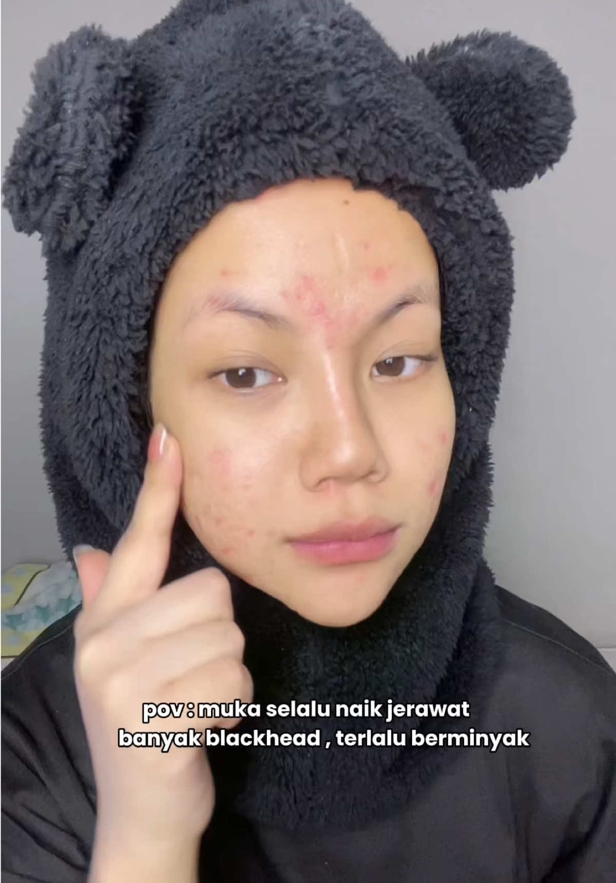 siapa sini banyak blackhead ! boleh start pakai Salicylic Acid 🤍🫶  #SensitiveSkin #dermatologisttested #Facerinna #Facerinnamy #fyp @Facerinna my 