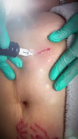 #Dehnungsstreifen #schwangerschaftsstreifenbehandlung #beauty #kosmetikwürselen #beautyaachen 
