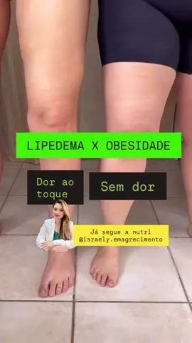 O lipedema não é sobrepeso. É uma condição inflamatória e hormonal, que faz o corpo acumular gordura de forma desproporcional, principalmente em pernas, quadris e braços. Também vem acompanhada de dor, inchaço, sensibilidade ao toque e hematomas frequentes. Por isso, dietas comuns ou restritivas não tratam o lipedema. Porque o foco não deve ser apenas o peso, e sim desinflamar, equilibrar os hormônios e restaurar o metabolismo. 🍃 Dentro do meu método Desinflame e Emagreça, o processo é dividido em três passos: 1️⃣ Reencontrar o equilíbrio: Começamos com uma alimentação anti-inflamatória, estilo low carb, ajustando vitaminas e minerais, equilibrando hormônios e melhorando a saúde intestinal. É aqui que o corpo começa a responder, desinchando, ganhando energia e diminuindo dores. 2️⃣ Acelerar os resultados: Com o corpo preparado, entramos com estratégias mais avançadas, como a cetogênica e a mediterrânea, ajustadas de forma individualizada. Cada mulher responde de um jeito e é isso que torna o método eficaz: é personalizado e respeita o seu metabolismo. 3️⃣ Viver um novo estilo de vida: Aqui o objetivo é manter o equilíbrio a longo prazo com uma rotina anti-inflamatória, alimentação rotacionada, ciclos de suplementos e estratégias voltadas para o emocional e o comportamento alimentar. Nada de viver em bolha. 💚 É possível se permitir comer uma pizza ou um doce sem culpa e sem voltar a inflamar, porque o corpo aprende a voltar ao equilíbrio. Esse é o caminho real: tratar a causa, equilibrar o corpo e transformar o estilo de vida. Se você quer aprender como aplicar o método Desinflame e Emagreça para tratar o lipedema, comenta aqui “DESINFLAME”👇🏼 #lipedema #lipedemalife #lipedemanãoéobesidade #retencaodeliquido #emagrecimentosaudável