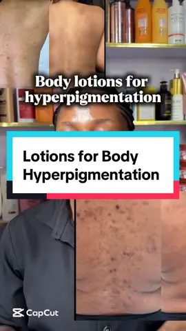 Body hyperpigmentation #hyperpigmentation #skin #skincaretips #skincaretips #skincare 