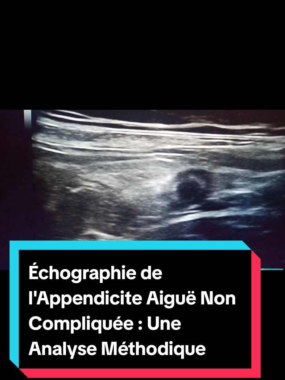 Échographie de l'Appendicite Aiguë Non Compliquée#virall #viral #fly #ap #baali 