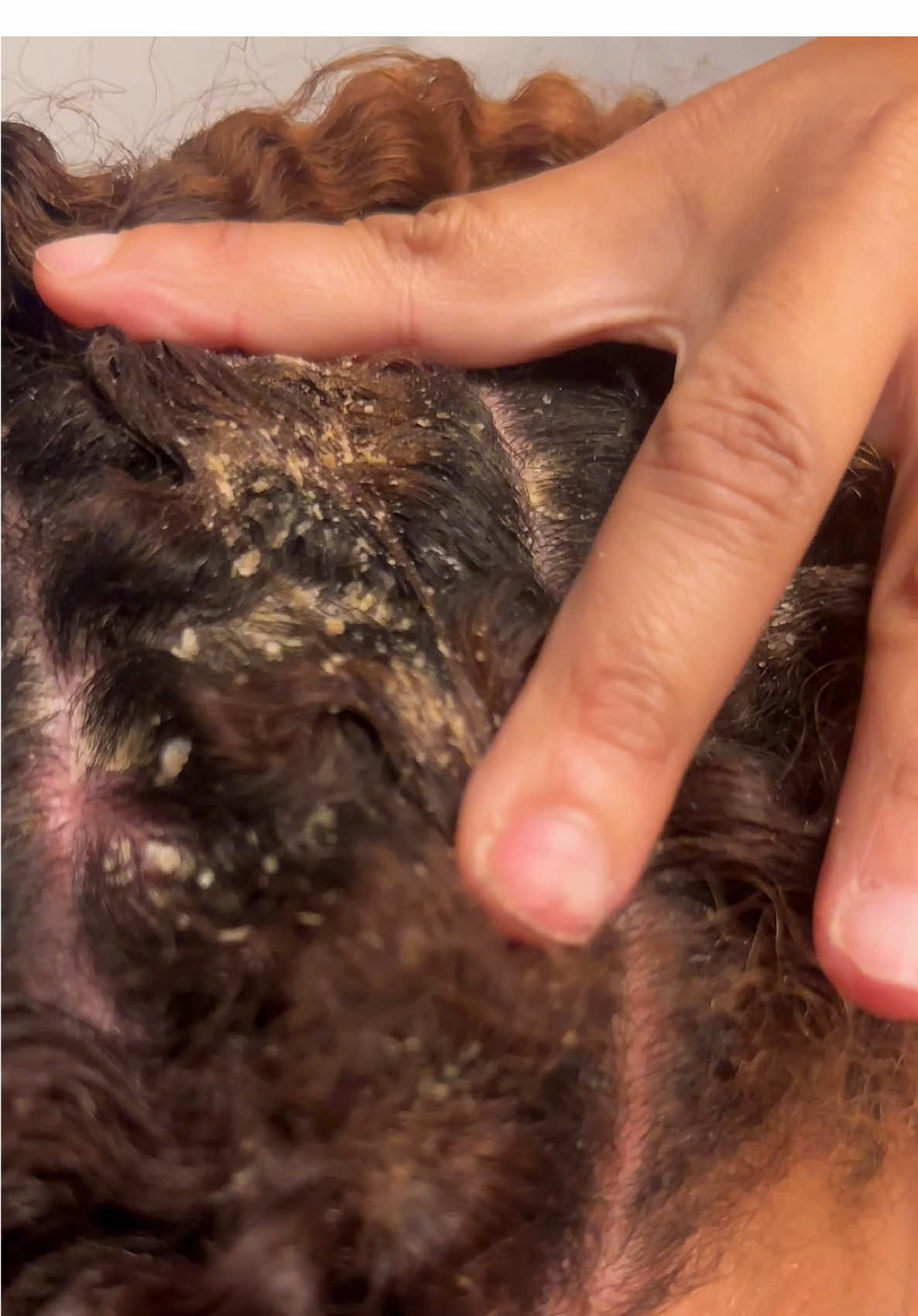 My scalp gets soooo inflamed 😣.. do yall deal with this or like picking scabs?? lol #scalppsoriasis #dandruff #dryscalp #psoriasistok #foryoupage 