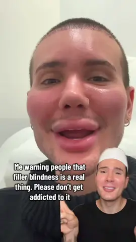 PLEASE DONT GET ADDICTED TO FILLER😭 #filler #lipfiller #beautyhack #beautytip #botox 