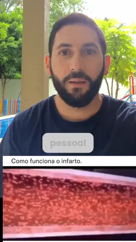 🫀 IAM com Supra de ST O infarto agudo do miocárdio com supradesnivelamento do ST (IAMCSST) ocorre quando há oclusão total de uma artéria coronária, levando à isquemia e necrose miocárdica. A placa aterosclerótica se rompe → forma-se um trombo rico em plaquetas e fibrina → o sangue deixa de fluir → o músculo cardíaco sofre. 💔 📌 Tratamento baseado em evidência: 🔹 Antiagregantes plaquetários (AAS + P2Y12) — impedem a agregação das plaquetas e estabilizam o trombo (diminuem mortalidade). 🔹 Anticoagulantes (heparina) — previnem a formação e expansão do coágulo. 🔹 Reperfusão imediata: ✅ ICP (angioplastia primária) — método de escolha se disponível em até 90 minutos. ✅ Fibrinólise — quando a ICP não está acessível, indicada até 12h do início dos sintomas (Tencteplase ou Alteplase). 🕐 Tempo é músculo! Cada minuto sem reperfusão significa maior área de necrose e menor chance de recuperação. 💡 Reconhecer, agir rápido e aplicar as condutas corretas salva corações — literalmente. #iam #infarto #acls