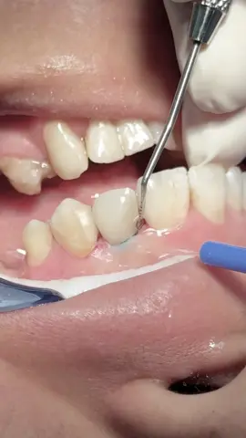 Composite veneer for anterior lateral tooth after removal of old restoration #dentist #UK 