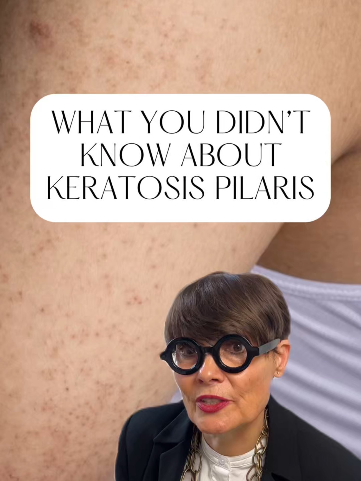 What you probably didn't know about #keratosispilaris!💪 #KP #chickenskin #personalhygiene #keratintreatment