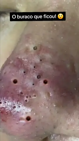 Remoção de cravo!  #cravossatisfatorios #videossatisfatórios #cravos #acne #foryoupage 