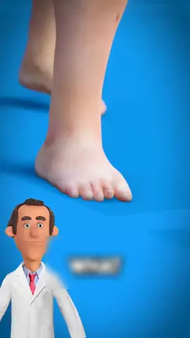 የቁርጭምጭሚት መወለግ ምንድነው? #ጤና #health #ethiopia 