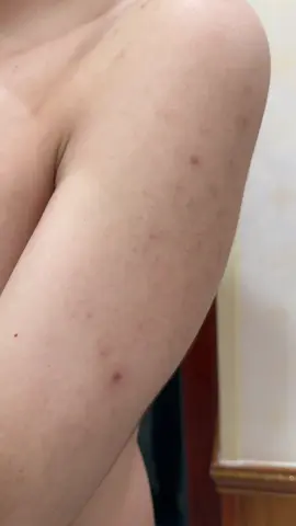 Bí mật chưa từng được bật mí #heyme #suatam #giammunlung #suatamgiammun #suatamnuochoa