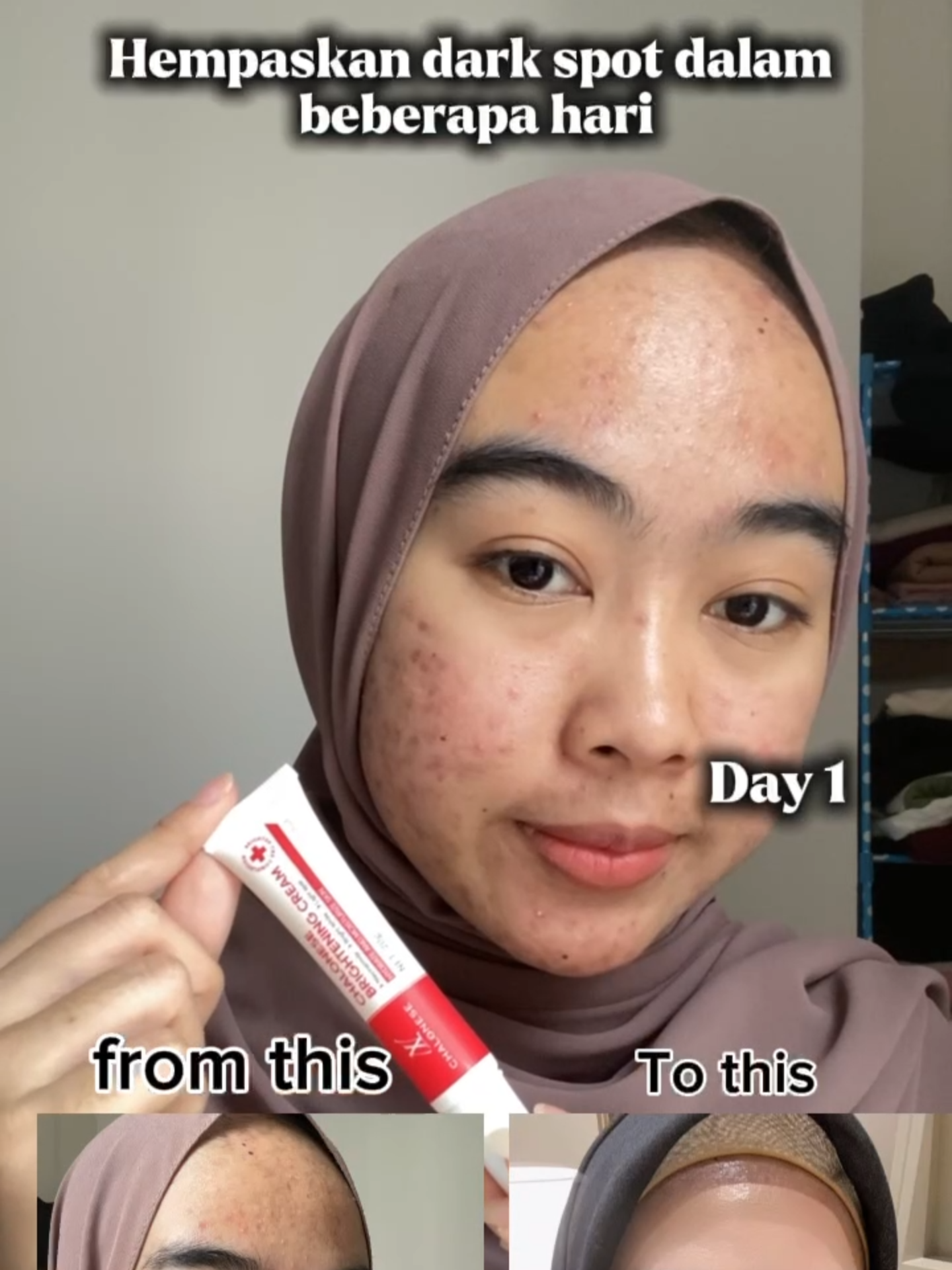 Hempaskan dark sp*t hanya dengan satu produk😱✨#fyppppppppppppppppppppppp #masukberandafyp #ForYourBeauty #skincareroutine #produkhemat #chalonesecreamwhiteningandfreckleremoval #skincareviral #skincaretips #viralvideo1million #chalonese #chaloneseskincare #garishalus #wajahglowing #cerahglowingnatural #mencerahkanwajah #edukasi #promoguncang1010 #guncang1010 #4u #H