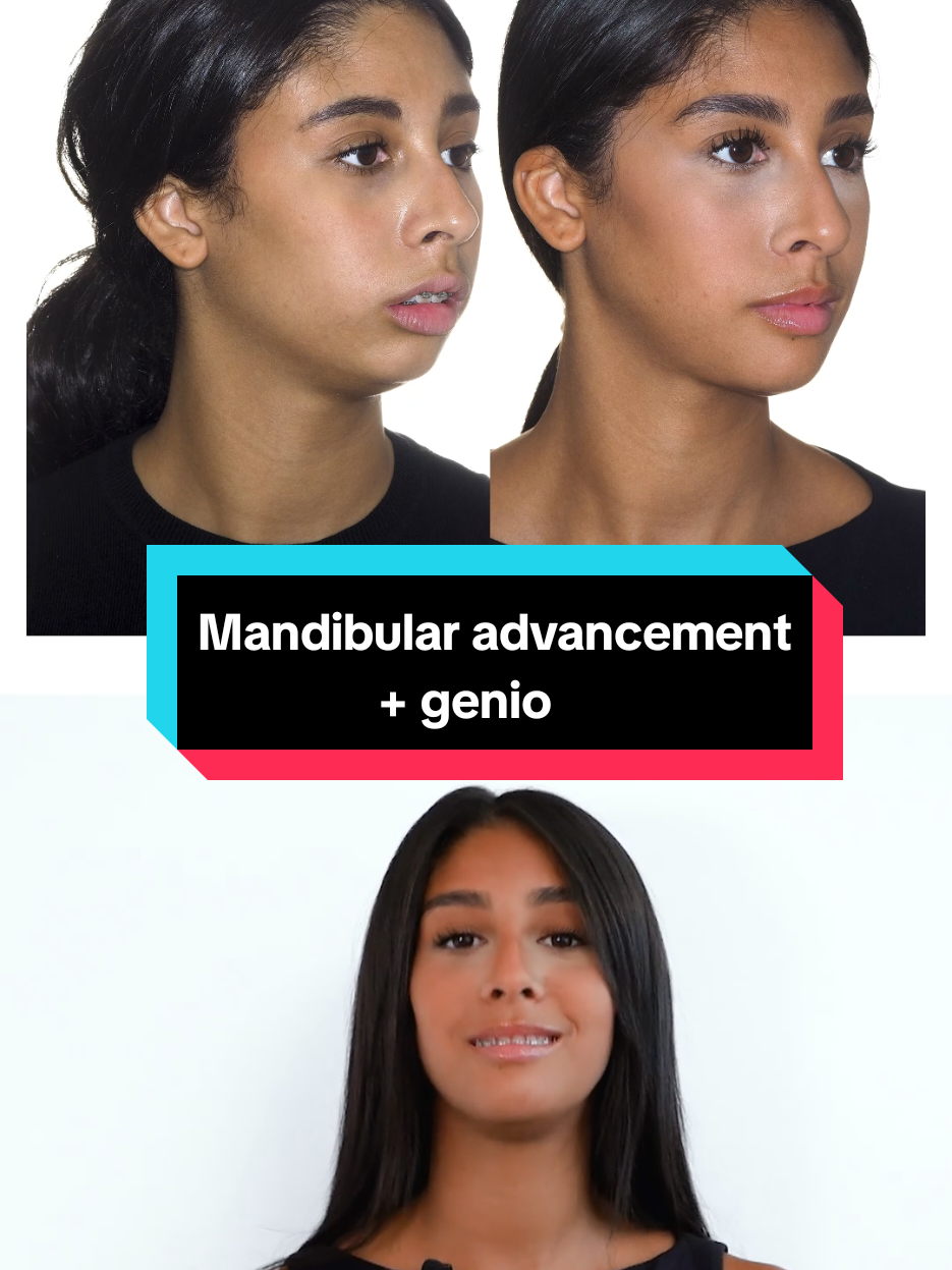 Doha's transformation before and after mandibular advancement and genioplasty. #institutomaxilofacial #antesydespues #orthognathicsurgery #beforeandafter #jawsurgery 