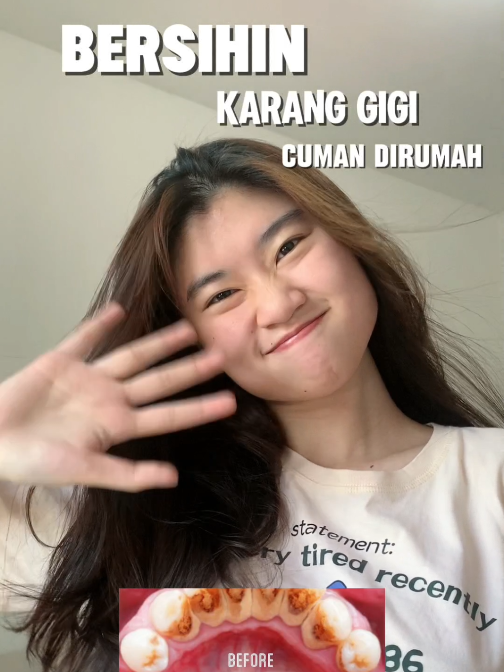 gaperlu mahal2 ke dokter lagi sekarang cukup pake @versident_official   #versidentshinningbrightteeth #pemutihgigi #karanggigi #solusigigikuning 