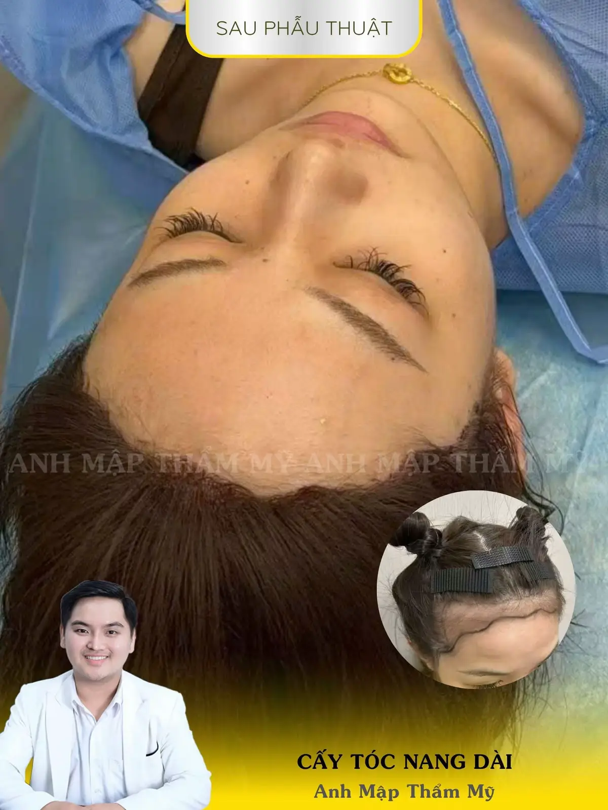 ✨ Tạm biệt mái tóc thưa thớt, chào đón mái tóc dày khỏe, tự nhiên với công nghệ cấy tóc nang dài tại Anh Mập Thẩm Mỹ! #anhmapthammy