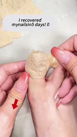 Are these patches a SCAM? I tried them so you don't have to.#tiktokshopcreatorpicks #tiktokshopfalldealsforyou #tiktokshopfinds #tiktokshopblackfriday #nailcare #toenail #elaimei #fungal #nail #fyp #fungalnails #antifungal #tiktokmademebuyit