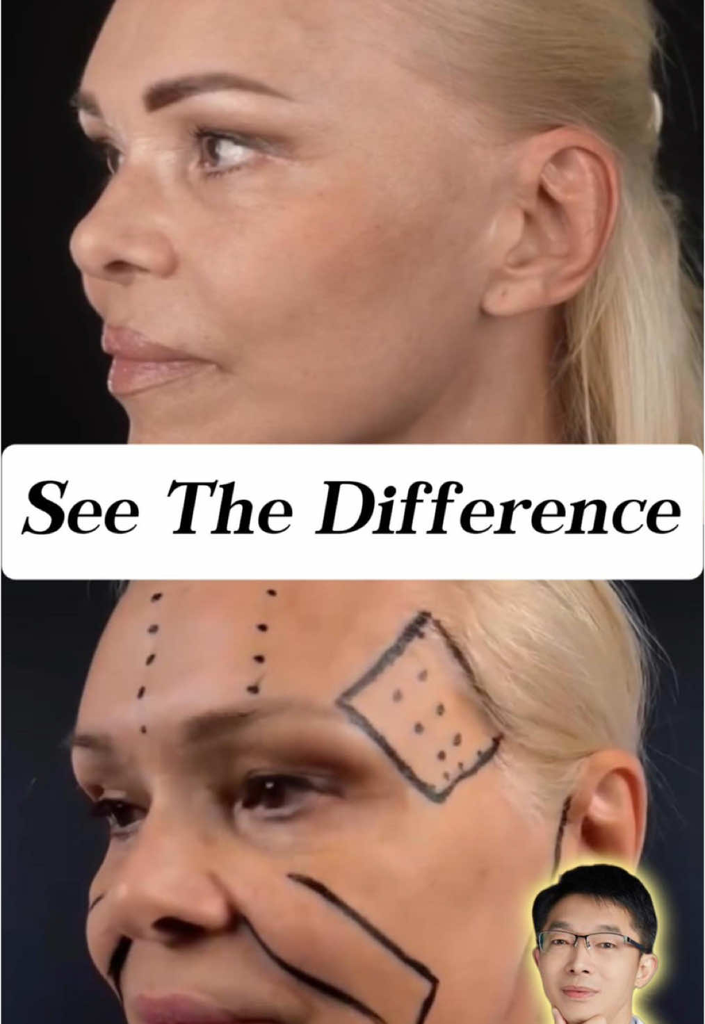 Our lovely 56-year-old patient from the U.S. came to Shanghai seeking a natural yet powerful transformation. She was concerned about sagging skin around her jawline and neck — what many call the “turkey neck.” Dr. Wang performed a deep-plane facelift and necklift, repositioning the deeper SMAS layer to restore firmness and youthful contour. Just one month later, her jawline is defined, her neck smooth, and her overall appearance 10 years younger. Most importantly, she said: “I finally recognize the confident woman in the mirror again.” #facelift #necklift #headlift #DeepPlaneFacelift #FaceliftShanghai #FaceliftExpert #SMASlift #NaturalRejuvenation #YouthfulContours #DrWang