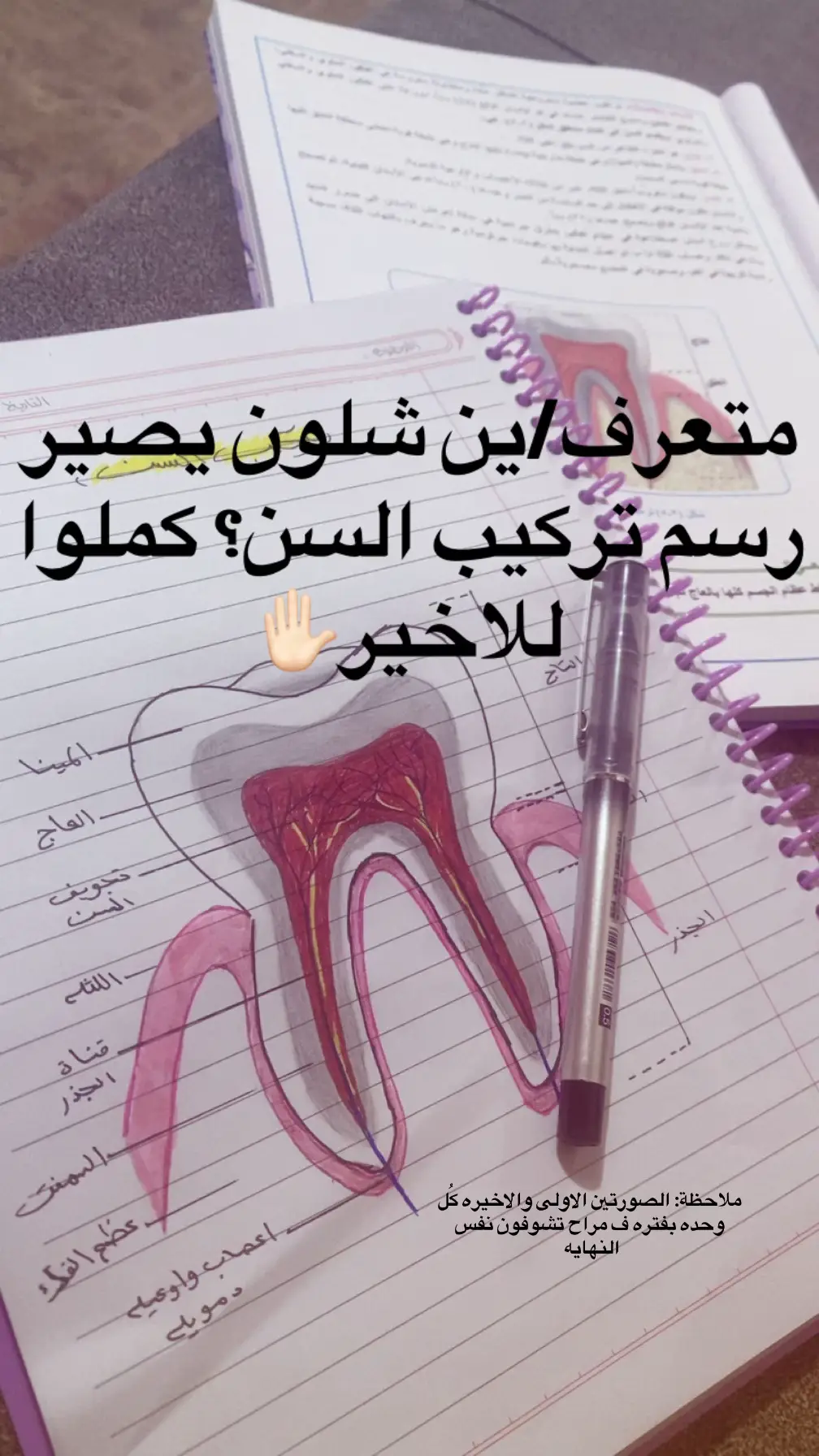 طريقة رسم تركيب السن(طلاب الثالث) الڤيد مؤقت(لو تكبرون حجم السن يكون احسن واوضح)#ثالثيون #ثالثيون_2026 #الشعب_الصيني_ماله_حل😂😂 #اكسبلور #parati 
