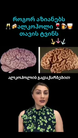 როგორ აზიანებს ალკოჰოლი თავის ტვინს?  #ფორიუზე #ფორიუ #ჯანმრთელობა #ჯანსაღიკვება #ექიმი 