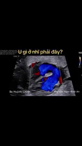 💗 U nhầy nhĩ phải ở thai nhi là khối u lành tính nguyên phát của tim, nhưng hiếm gặp, chiếm tỷ lệ < 10% các u tim thai. Khối u thường xuất phát từ vách liên nhĩ, có thể di động trong buồng nhĩ phải, gây tắc nghẽn dòng máu tĩnh mạch chủ hoặc van ba lá. Siêu âm tim thai cho thấy khối tăng âm, ranh giới rõ, di động theo nhịp tim, giúp phân biệt với u cơ vân. Tiên lượng phụ thuộc vào kích thước, vị trí và ảnh hưởng huyết động. Phần lớn các trường hợp nhỏ ổn định trong thai kỳ, nhưng khối lớn có thể dẫn đến rối loạn nhịp, tràn dịch màng tim hoặc suy tim thai. Điều trị chủ yếu là theo dõi định kỳ bằng siêu âm tim thai, phẫu thuật sau sinh chỉ đặt ra khi có biến chứng nặng. #unhaynhiphai #ditattimthai #bshuynhchinh @Phụ sản Ngọc Bình An 