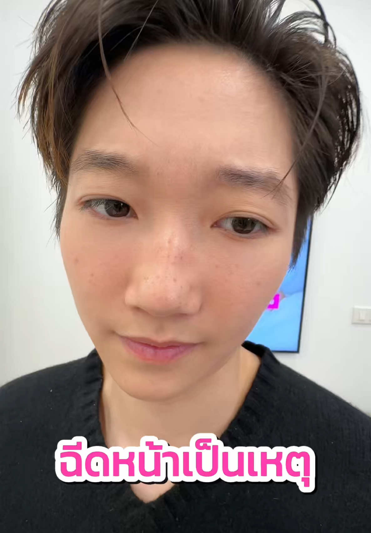 เอาล้าววว😳 #megaclinic #เมกะคลินิก #ฉีดหน้า #ญา #ญาดรีม 