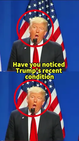 Have you noticed Trump’s recent conditions #fyp #usa #us #foryou #news #celebrity #trump 