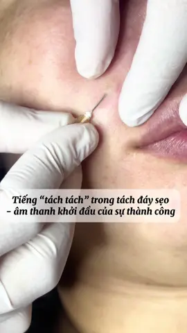 Các bạn đã làm sẹo có nghe tiếng “tách tách” quen thuộc này không? #xuhuong #triseoro #spatriseohaiphong #spatrimunhaiphong #hảiphòng 