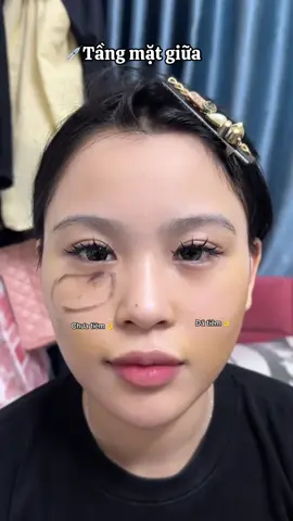 Giải pháp để lấy lại sự tươi trẻ là nên tiên tầng mặt giữa  Không quá nhiều HA trên một vị trí mà cải thiện toàn diện các vùng tổng quát hết  #đàotaohocvien #HA #filer #môibaby #botox 