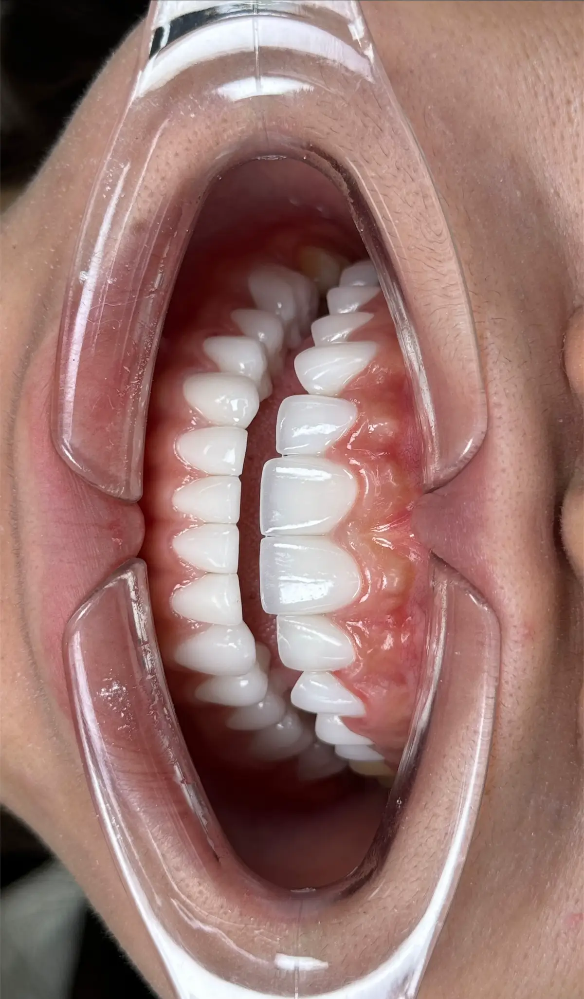 vuông quá không quen😊#DSD #TikTokAwardsVN #xuhuong #smiledesign #drT 