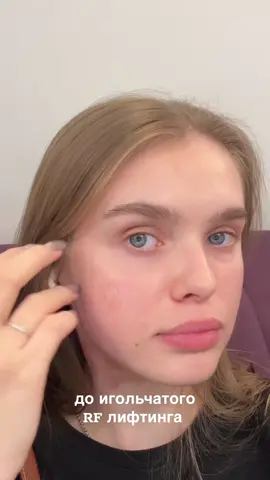 после RF-лифтинга восстановление проходит в разы легче, чем после лазерной шлифовки — и результат всегда предсказуемый 🦋#рфлифтинг #рубцы #лечениеакне #акне #fly 