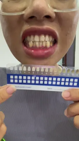 Trắng sau 1 lần dùng #xuhuong #kemdanhrang #closeup 