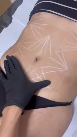 Nosso queridinho TF Shape, acabando com a gordurinha localizada e retraindo a pele ❤️