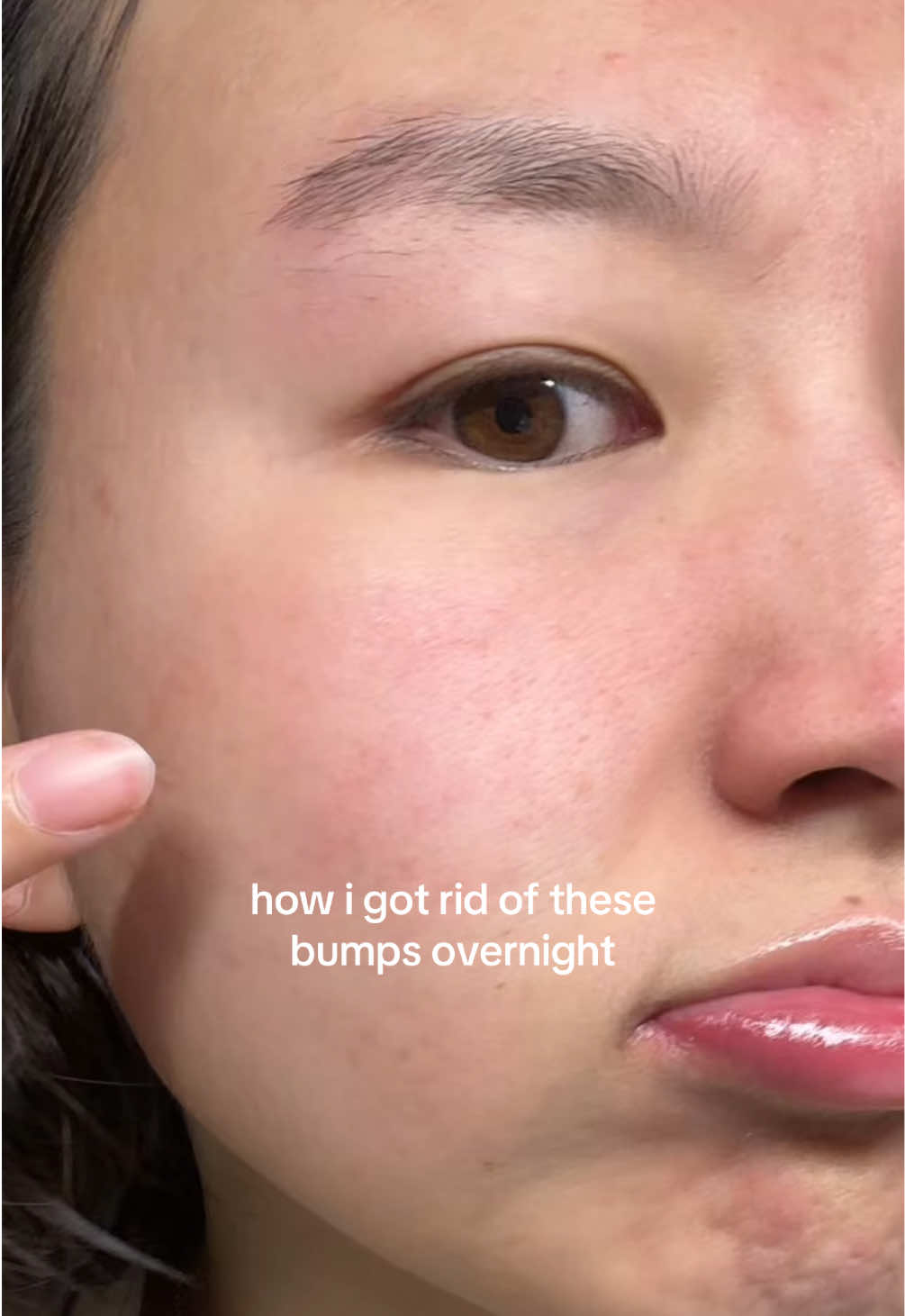 me after it worked: 👁️👄👁️ #skincare #fungalacne #acne #arencia #skincarehack #fyp @Arencia 